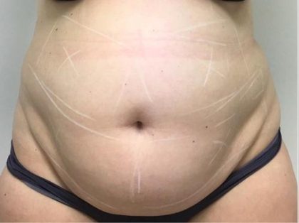 TruSculpt ID Before & After Patient #1567